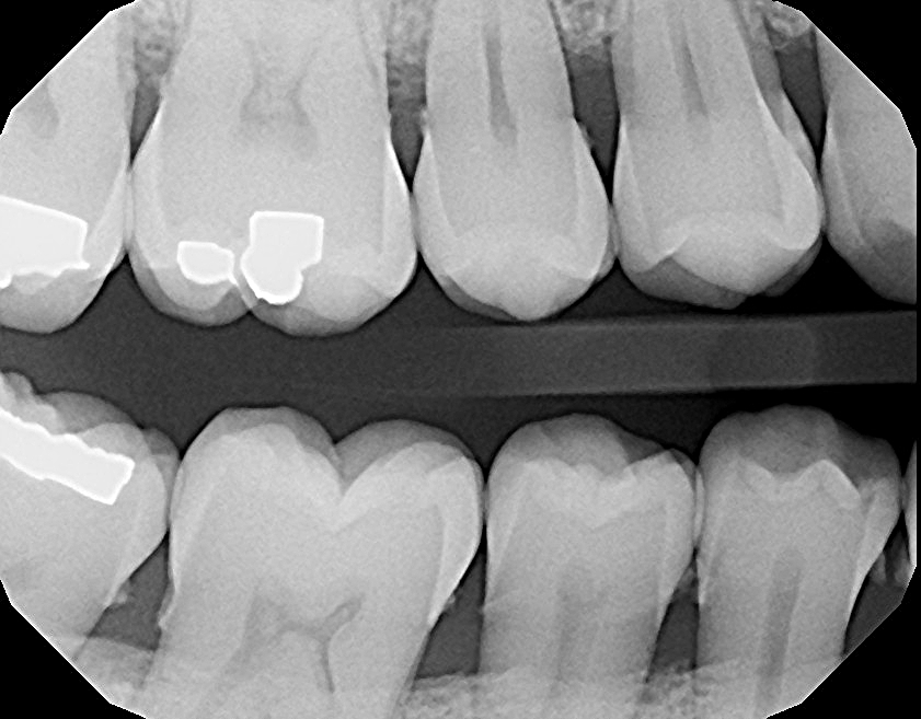 DentalMethod Medium Bone loss